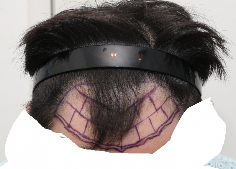 New Hair Seoul branch incision hair transplantation late on the 6th day (2,000 hair follicles)