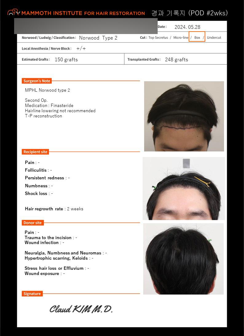 2nd round of diamond slit M-shape transplant (reinforced surgery) at Mammoth Hairline in Busan after transplant at closed hospital! (After 2 weeks)