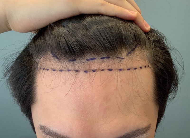 Immediately after Morplus surgery (cutaway 2700mo)