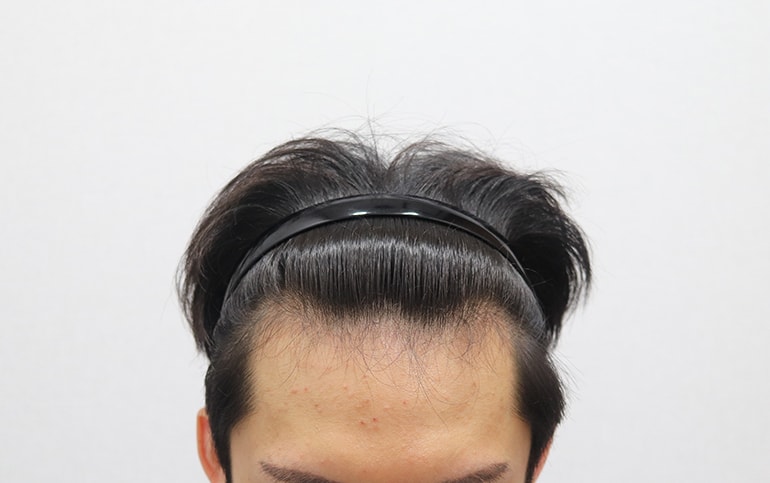 7 months of Morplus surgery (cutaway 2,700mo)