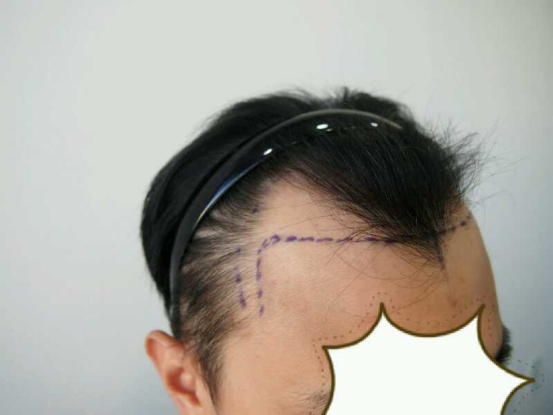 M자 이식 10일차 딱지제거후 입니다