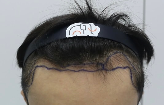 Apgujeong Mamos Hairline 2nd Review