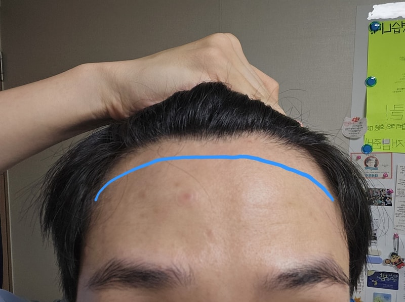 움찬 M자 비절개 모발이식 1일차 후기