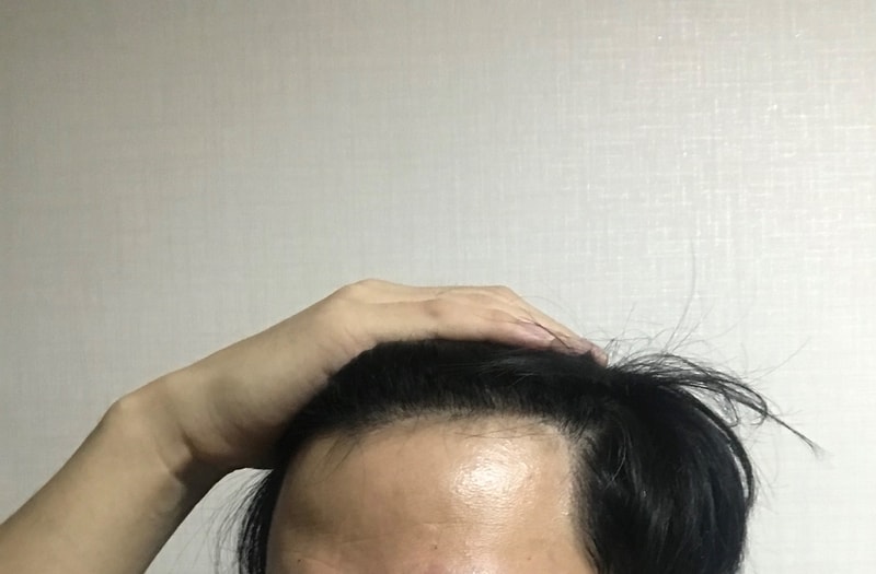 ダナロングヘアの無毛髪移植ラインが本当にきれいに仕上がりました