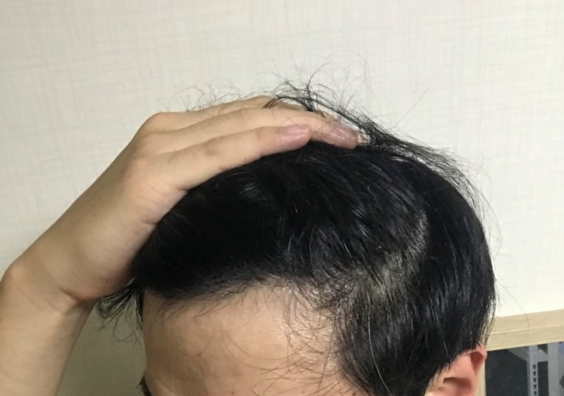 13ヶ月経過したロングヘアに無削髪を満足しています