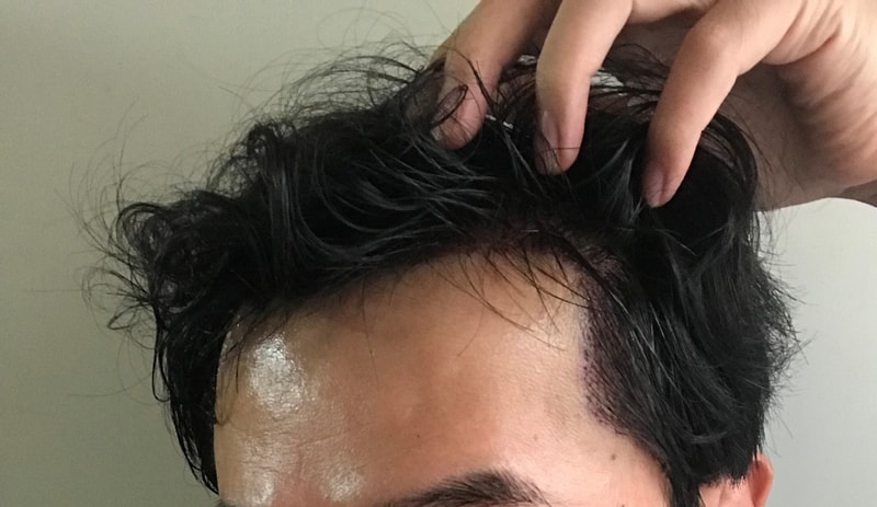 ダナロングヘア手術1ヶ月までの期間別写真集