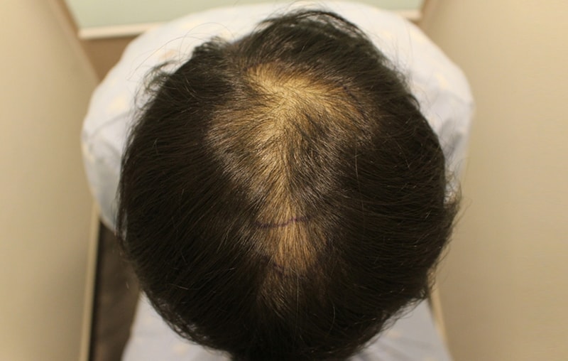 8th month of kiln/orthodox implantation. When I saw my hair that was growing