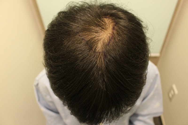 [Dr. Charm] It's the density, thickness, volume of implantation that's getting dense.