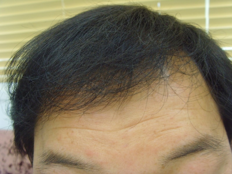 수술후.JPG