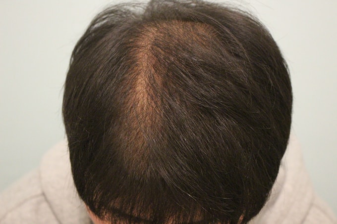 수술후 9개월.JPG