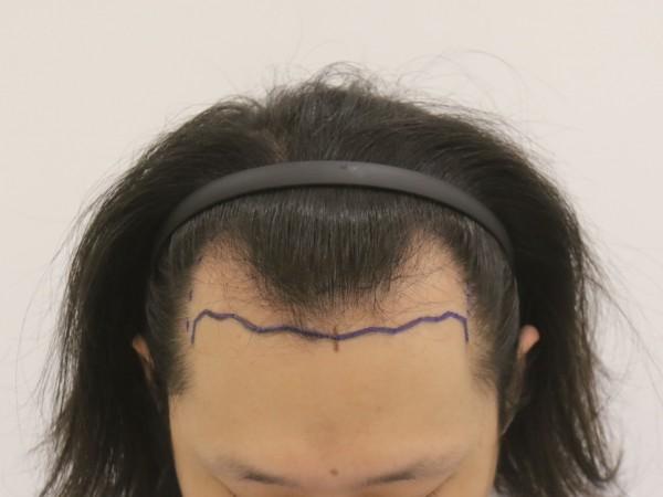 Busan Mammoth M-shaped hair transplant 14 days later, review