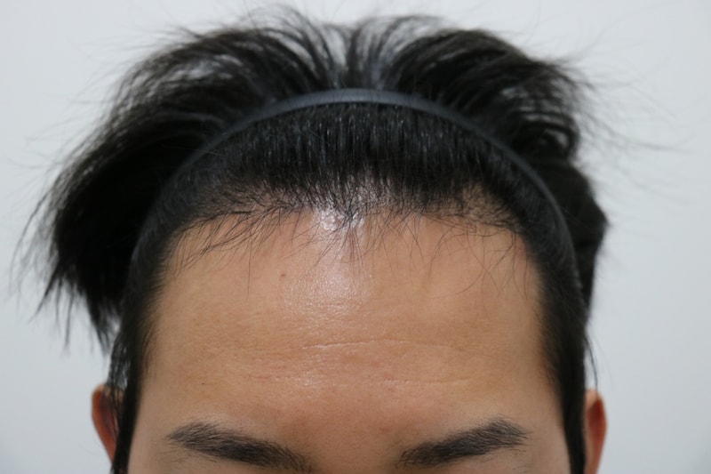 M자형탈모 비절개 4044모 이식 6개월차 후기입니다.