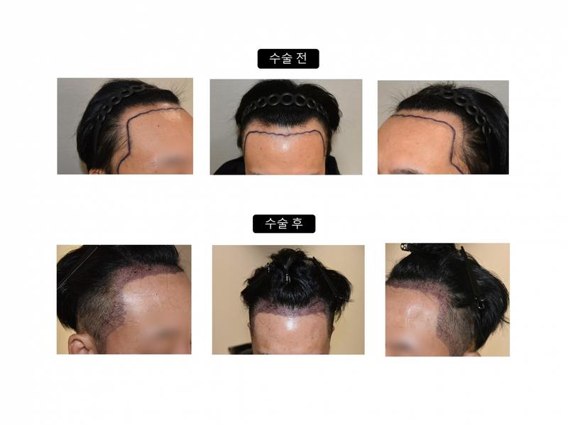 수술전후 이미지 대다모.jpg