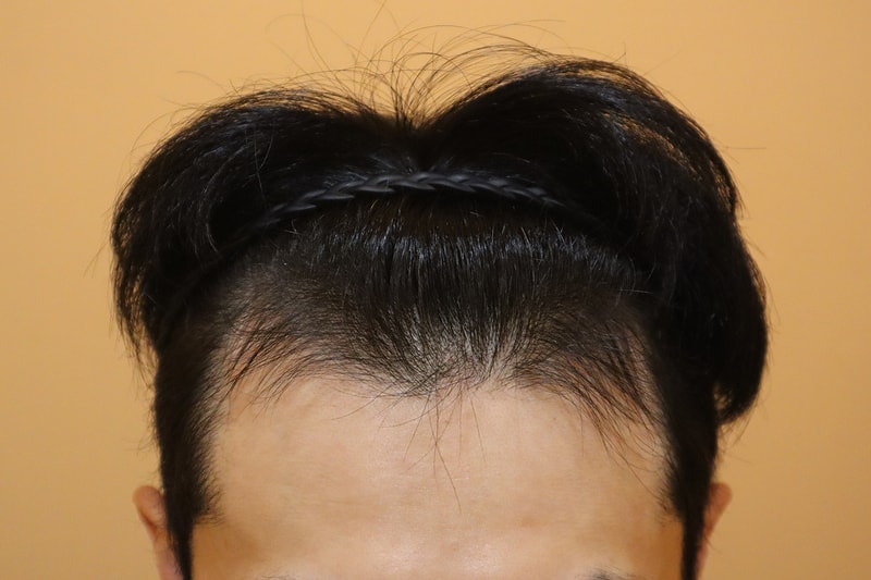 부산 헤어로의원 비절개 모발이식 1400모낭 m자복원 14일 후기