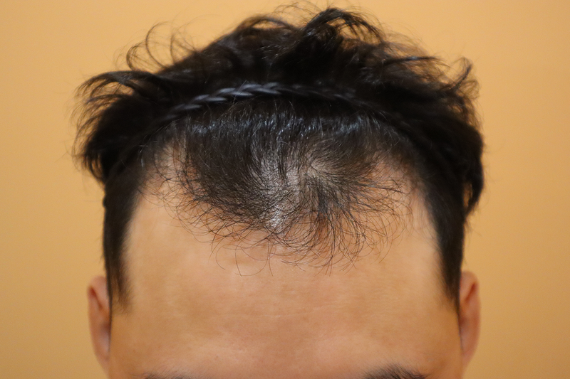 부산 헤어로의원 비절개 모발이식 6000모 14일 + 3일 후기