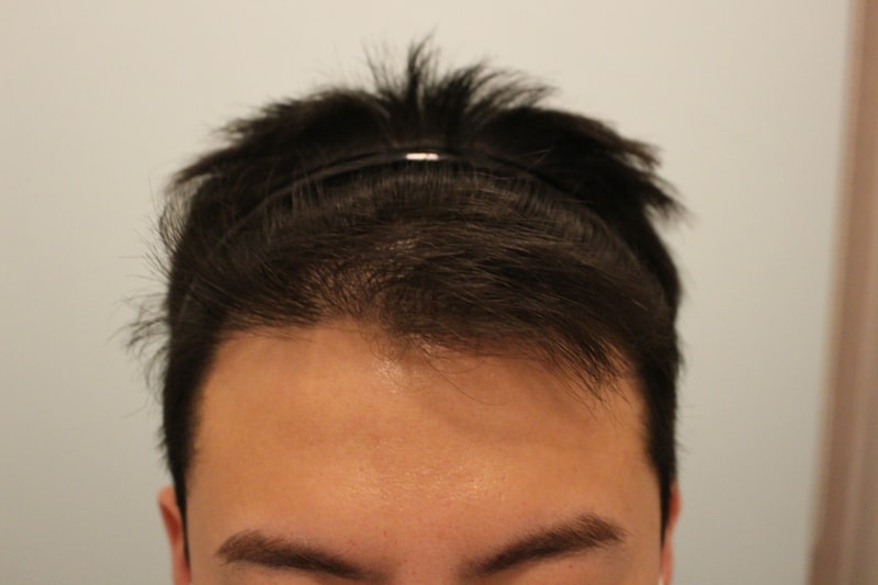 수술후 1년 1.JPG