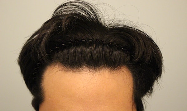 Men's Hairline Correction 1st Review-11th Day