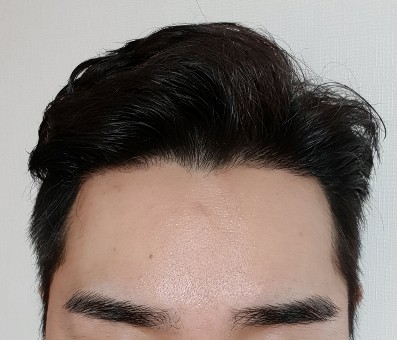 M字毛发移植1年后期，大茶母毕业。