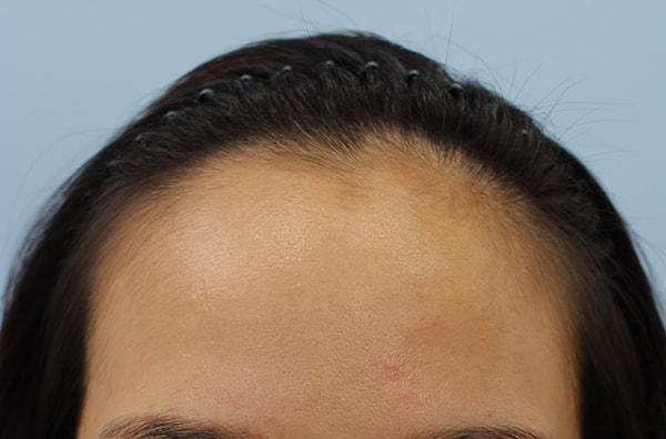 ヘアライン矯正5ヶ月病院に行ってきました！！