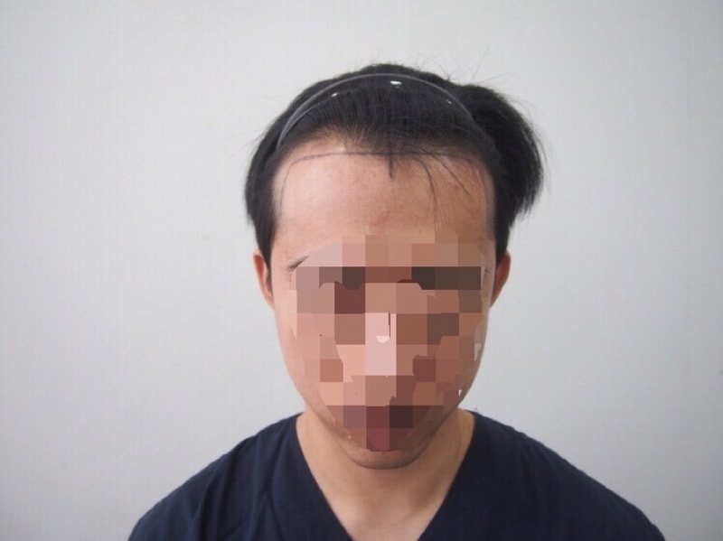 12月29日手術直前/直後14日経過写真