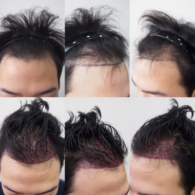 This is a non-excision on day 3 of transplantation! (Review please)