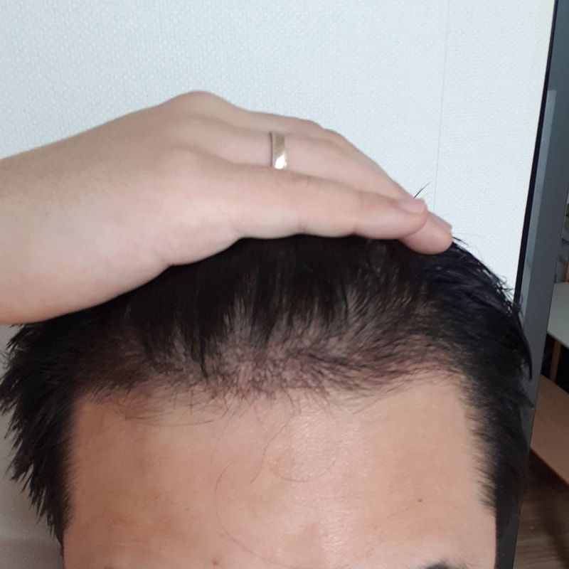 丸刈り1か月