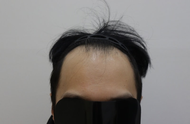 광주 압구정모비앙 절개식 모발이식 10개월 경과 후기