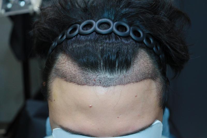 Review of the 10th day of hair transplantation in Apgujeong Mobien, Gwangju