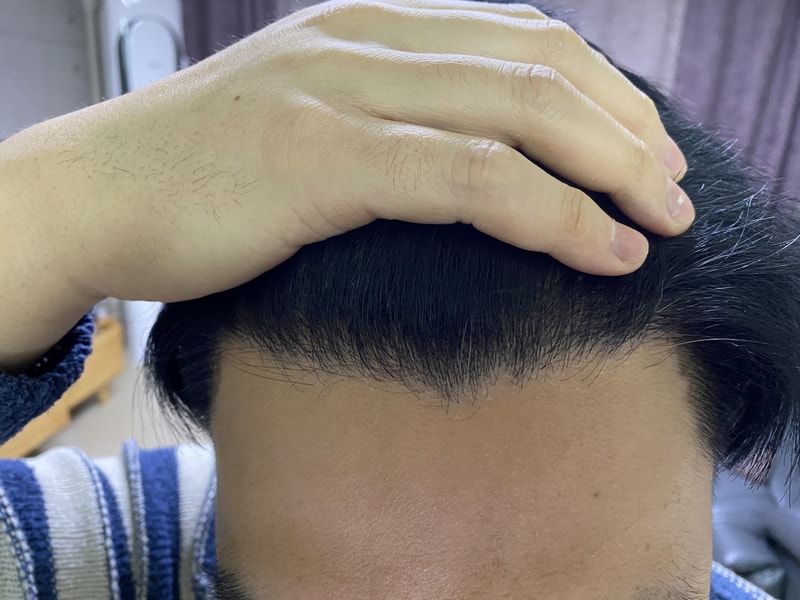 I'm eight months into my hair transplant