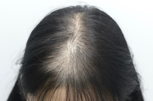 狎鸥亭Mammos Hairine医院接受毛发移植两周后。