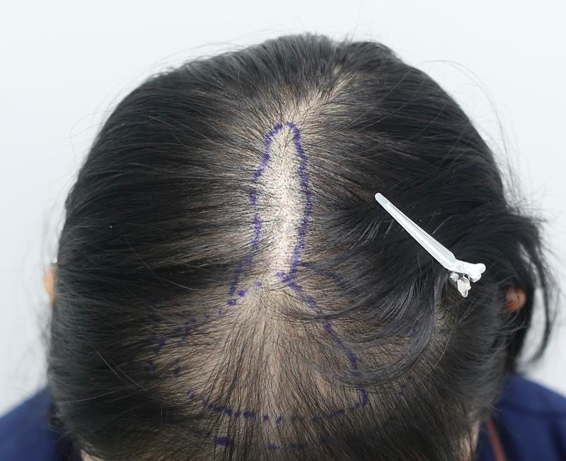 这是狎鸥亭Mammos Hairine医院接受毛发移植7个月后的后记。
