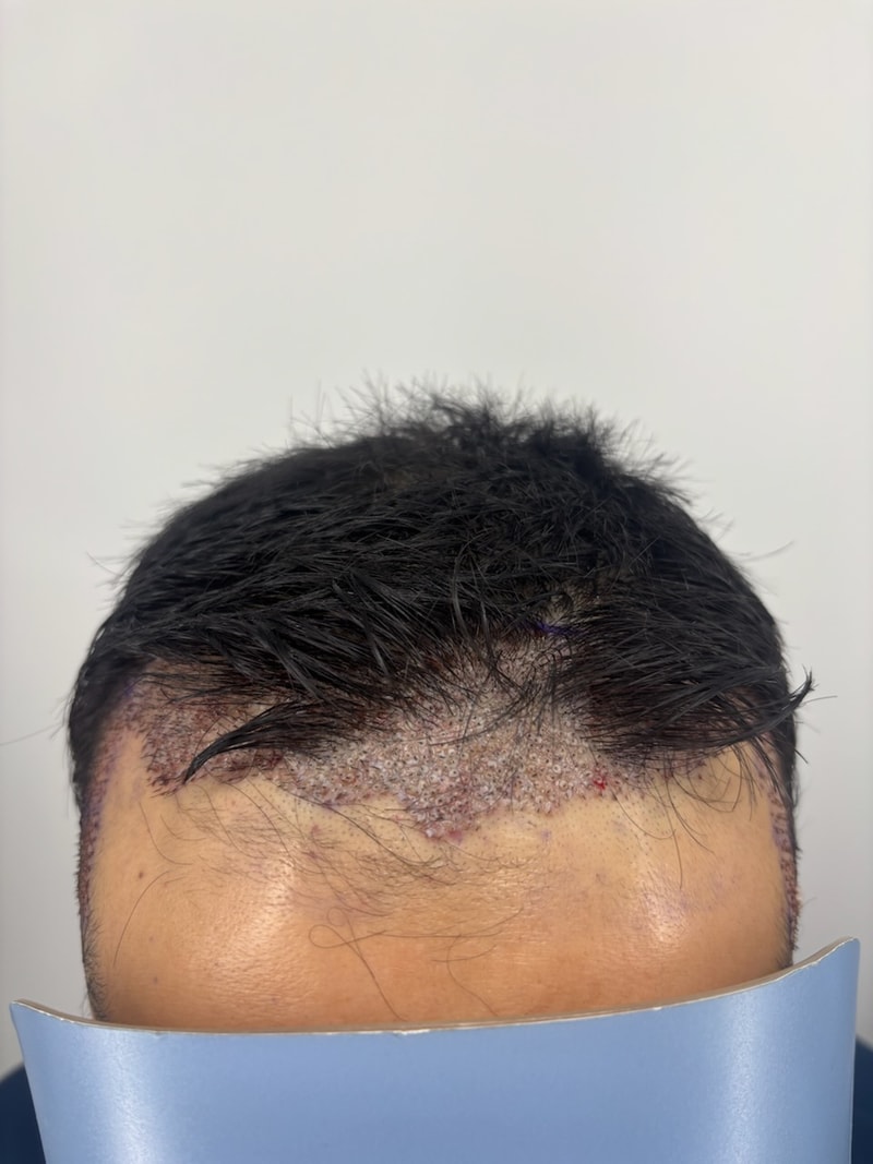 모발이식 1800모 12일째