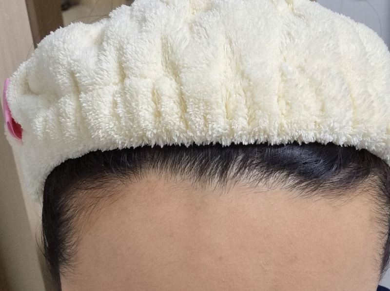モディヘアプラント毛髪移植6ヶ月目のレビュー