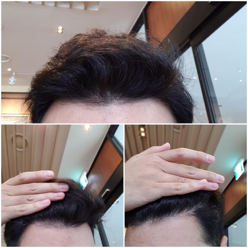 비절개 7개월차 후기 올립니다