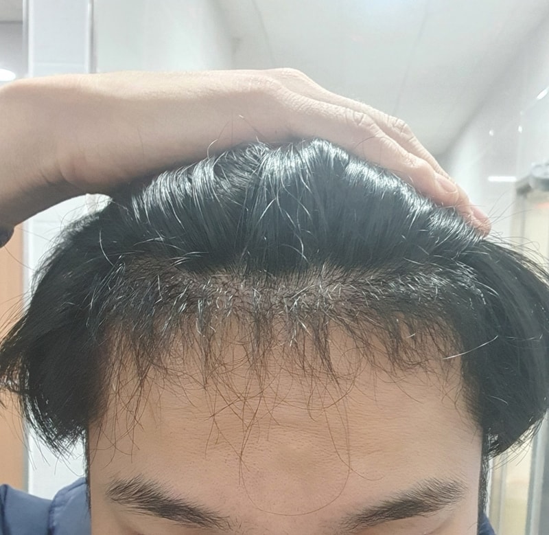 비절개수술 6개월차 경과