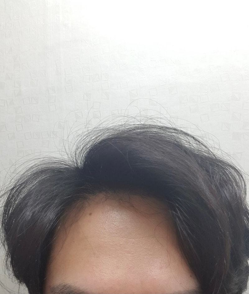 自然毛发移植7个月