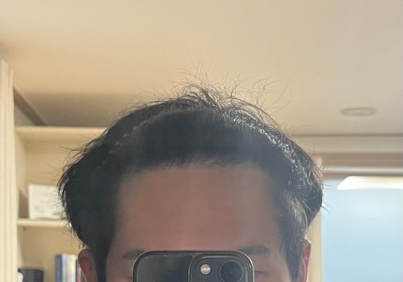 비절개 1200모낭 8개월차 후기