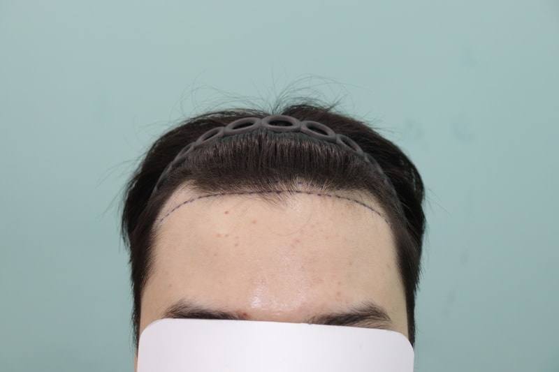 Gwangju Apgujeong Mobiang Hair Transplantation 6 Months Late