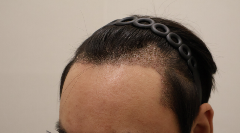 ドンタンヘアで毛髪移植医院3600本、第3週目経過後のレビュー
