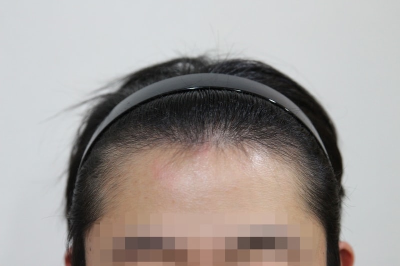 비절개 1400모낭 1년 경과