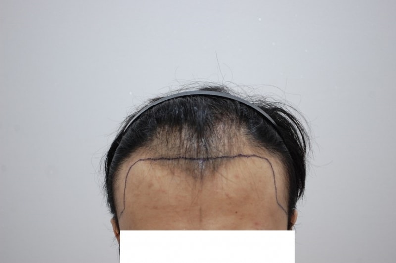 Three months after the surgery in Han Sang-bo (don't ask me the cost)