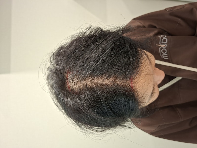 MOUDA CLINIC Women's Top Hair Loss Sectomy Week 3 Review