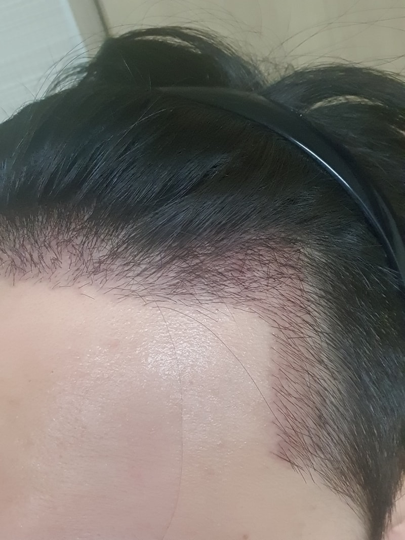 It's from the 2nd week of surgery