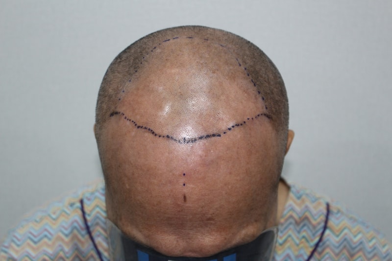 모더함 남성 4000모 전두부 전체 모발이식 당일후기