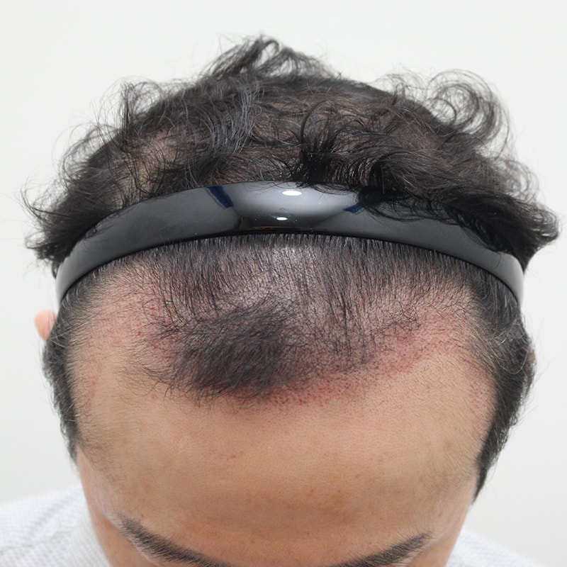 4.수술1개월째.jpg