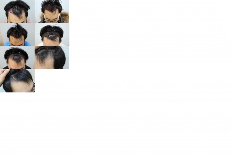 수술전.jpg