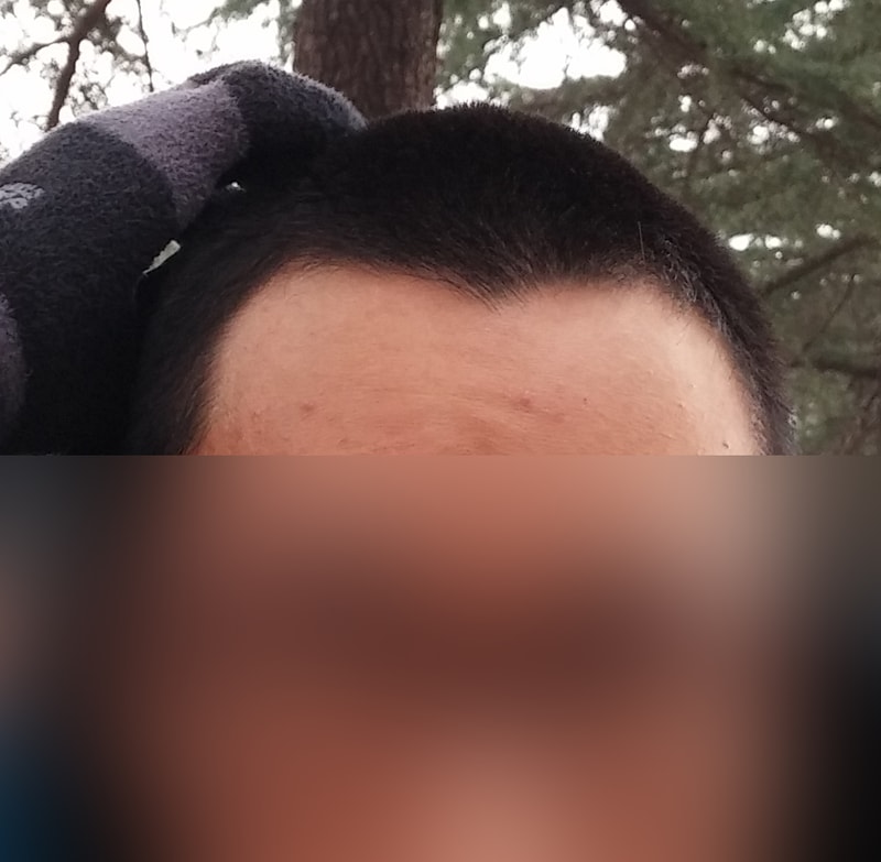 모앤블레스 비절개 슬릿 2800모 4개월 후기입니다