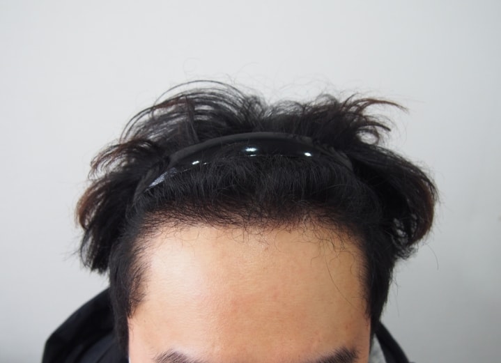母材城で非切開4ヶ月の後期です。