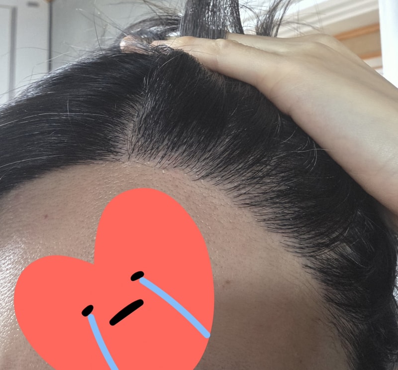 부산 리즈모 1년1개월 후기(재수술)