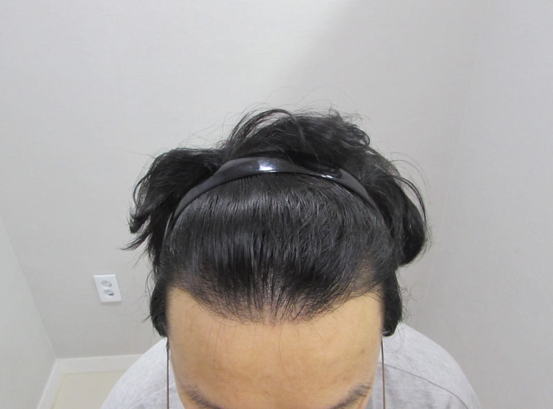 수술후2.jpg